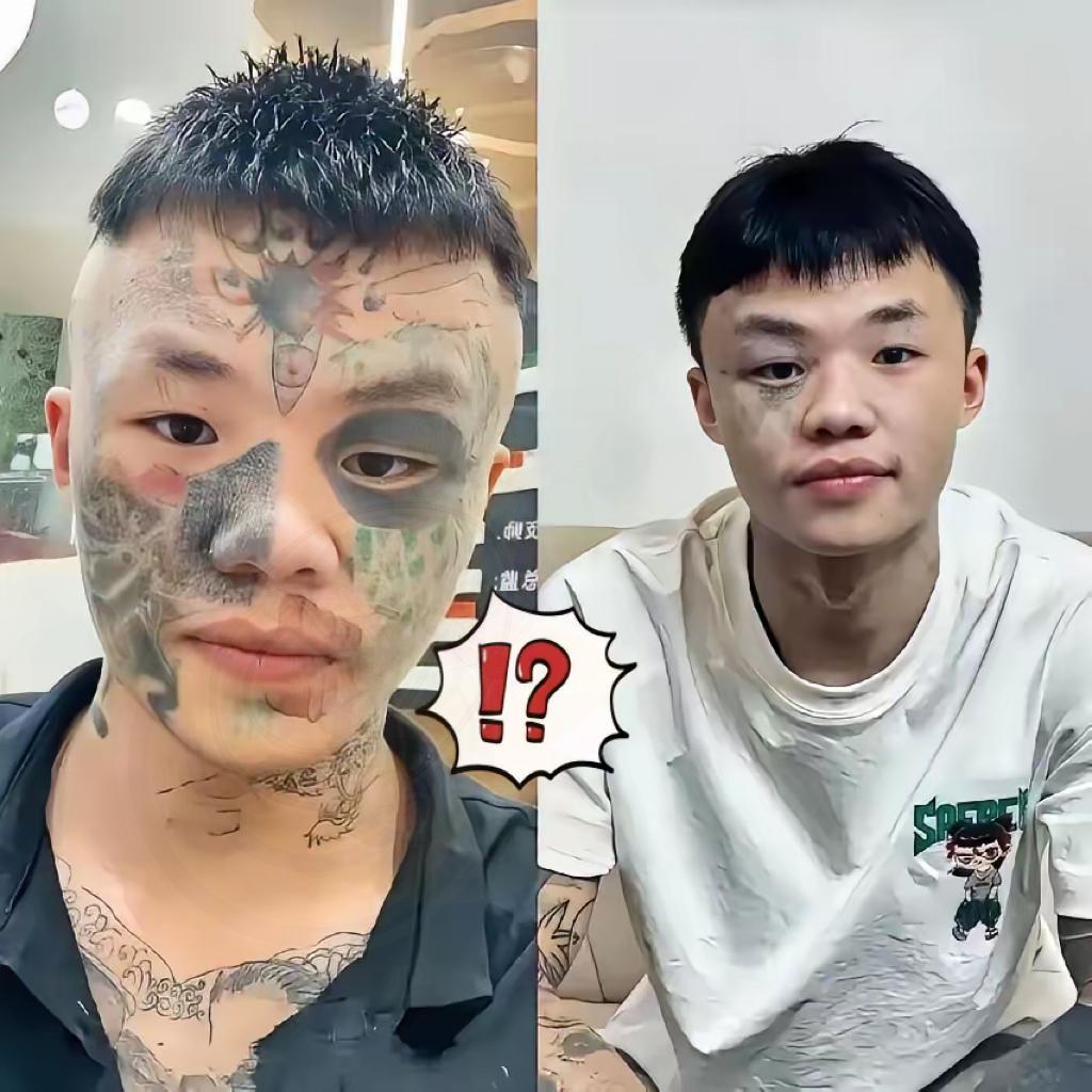 广东，纹面男孩夏朝勇为了洗掉年少时的纹身，已经做了三次激光清洗，再洗两次就能完全