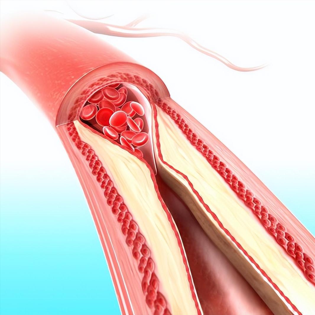 脑梗后遗症为何难避免？揭秘五大关键原因 1.错过了溶栓脑梗发作后的4.5
