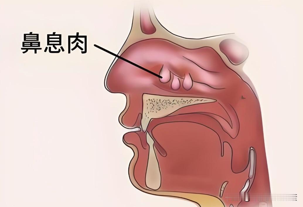 鼻窦炎只有手术能治好吗?鼻窦炎呢按照临床的病程时间，可以分为急性鼻窦炎和慢性鼻