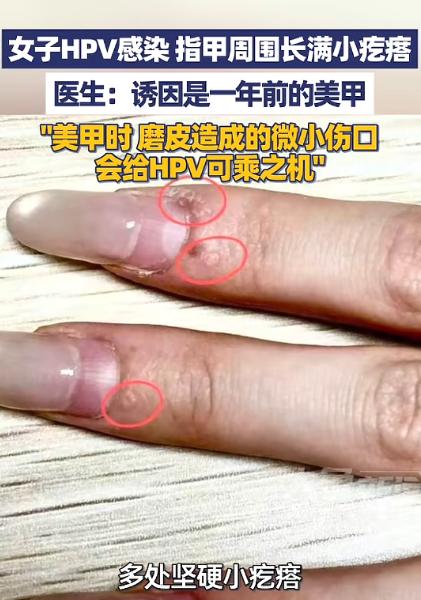 “太吓人了！”5月9日报道，浙江杭州，一女子发现她的指甲周边，长了许多粗糙坚硬的