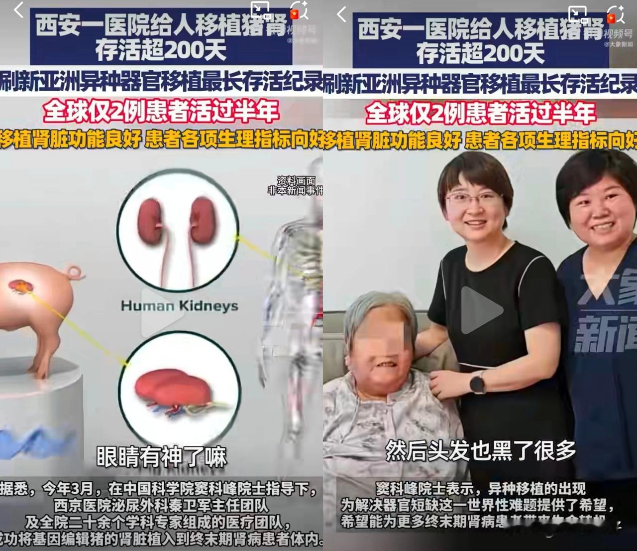医学奇迹！西安一猪肾移植患者存活超200天，生命奇迹正在延续！空