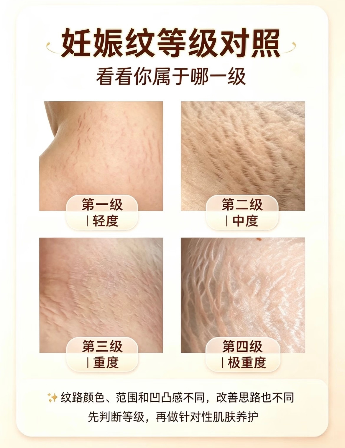 何穗妊娠纹何穗的妊娠纹也不明显啊，连初级都算不上，普通人的要更严重的多呀。热搜