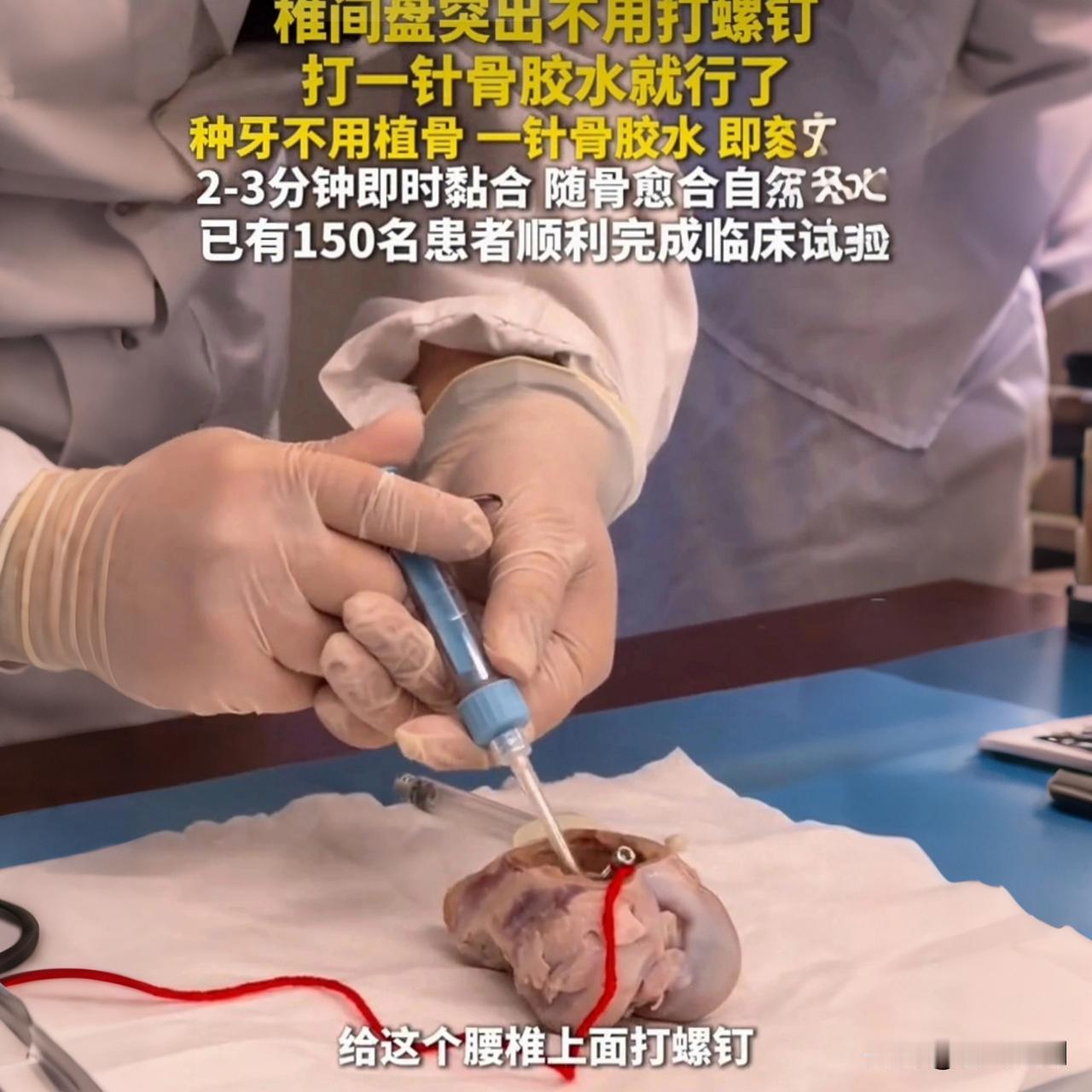 浙大“骨02”入中美审批通道，骨折不用打钢钉了！想象一下，几百年来，无论是你