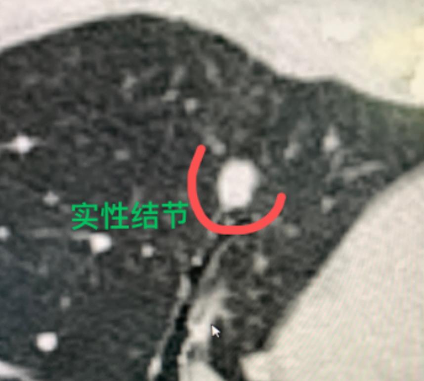 很多人查出肺结节都想着先观察、多拖一阵，觉得结节没变化就是安全的，但并不是所有结