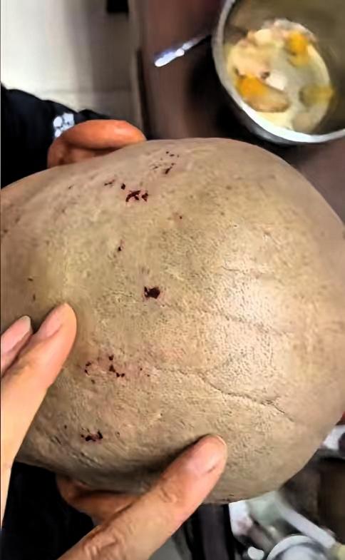 近日，天津一大爷花10元剃头，结果满头都是伤口，回家后女儿发现他后脑勺全是小