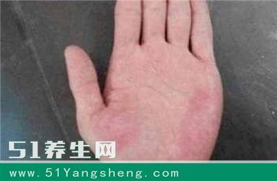 手掌这样是得了肝炎! 身上7处, 看出肝好不好