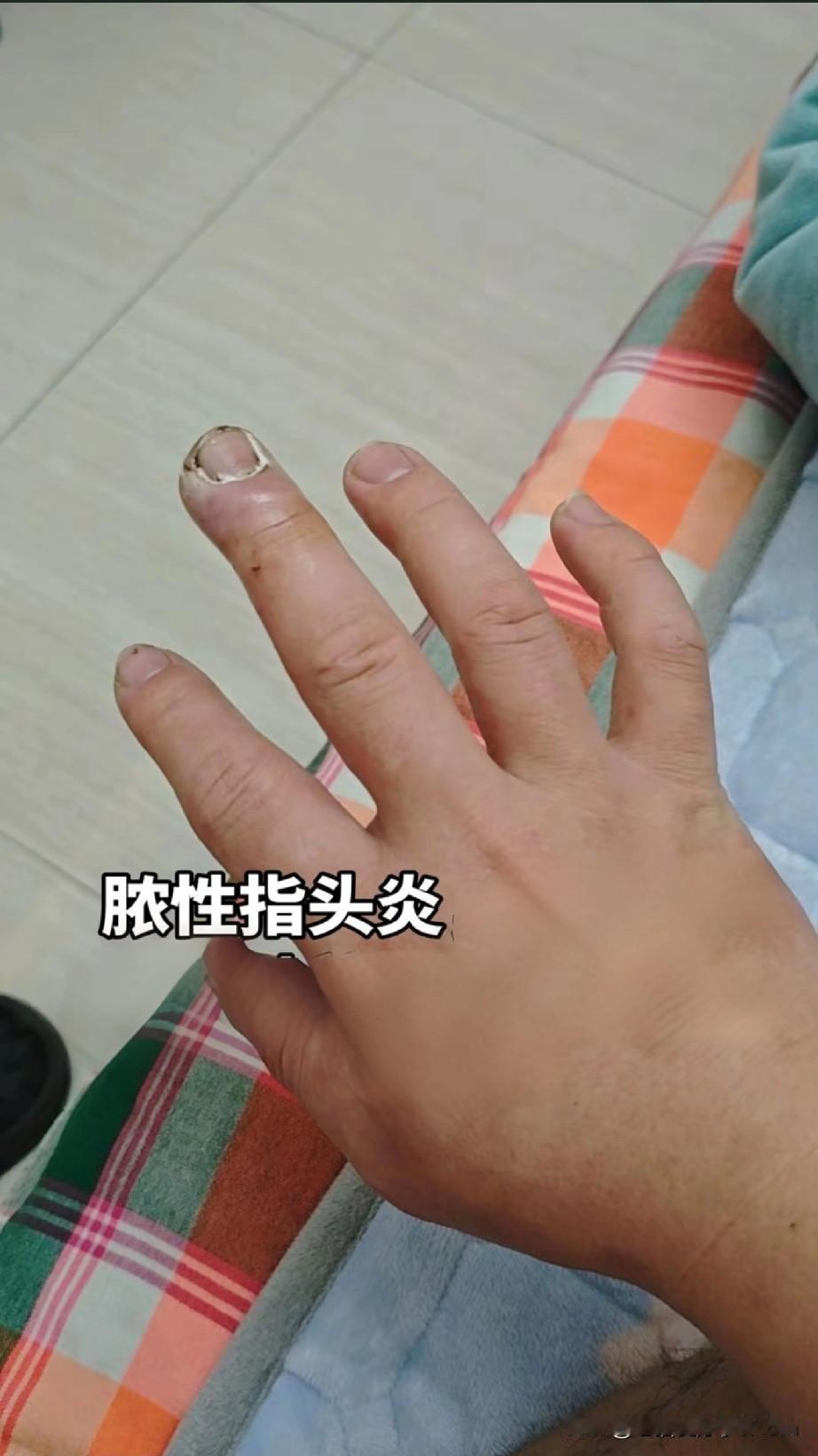 这种小症状千万别大意今天看到一个案例真的后怕！杭州11岁的小女孩小雨，一