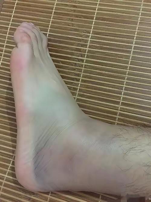 急性软组织扭伤：生栀子30克，生大黄30克，元明粉30克。打粉，用蛋清或醋调