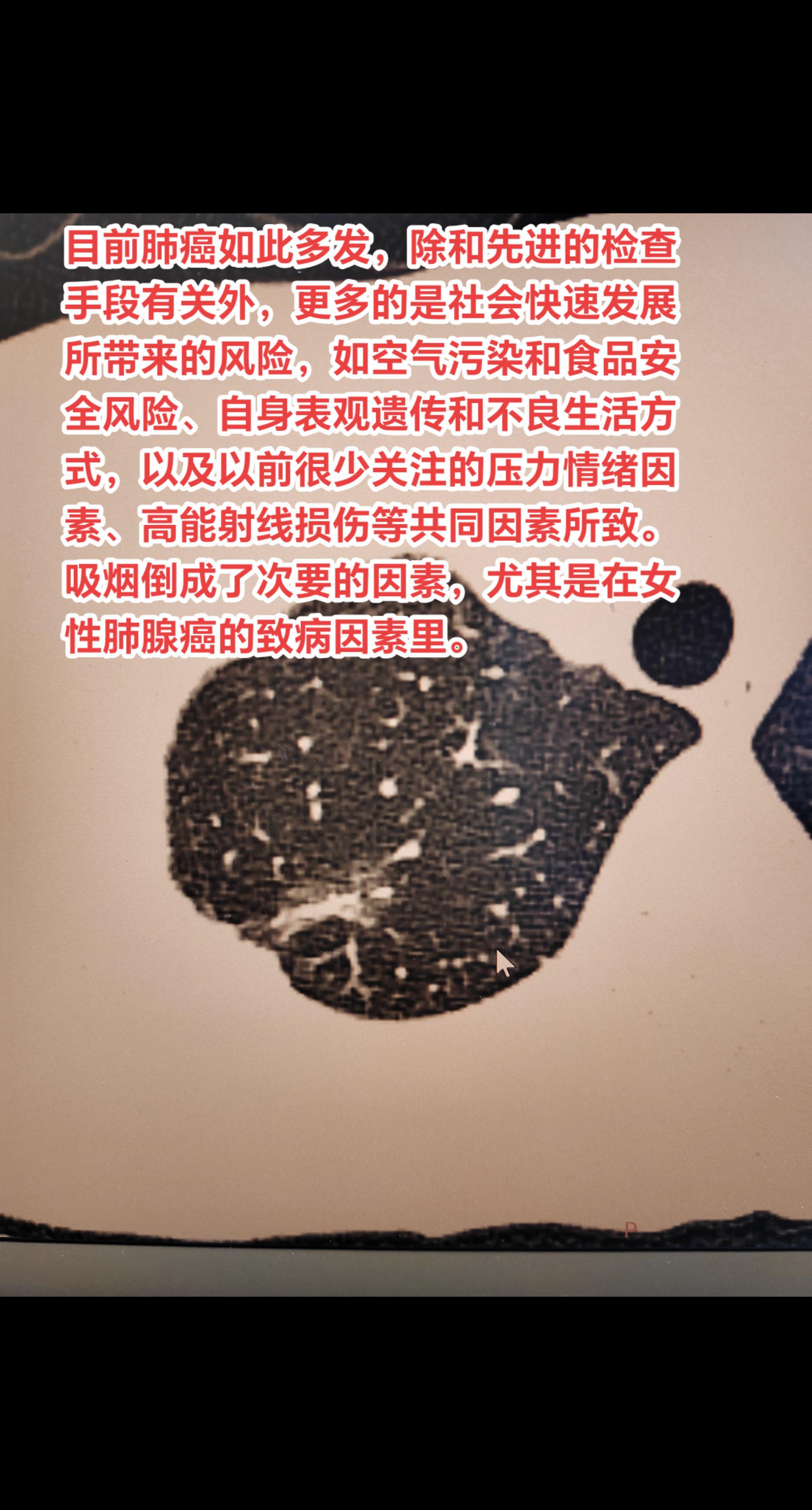恶性肺结节形成原因有哪些？目前肺癌如此多发，除和先进的检查手段有关外...