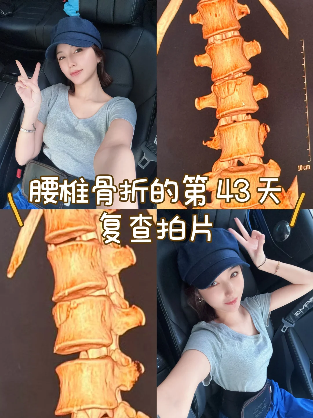 腰椎骨折的第 43 天 出门复查啦