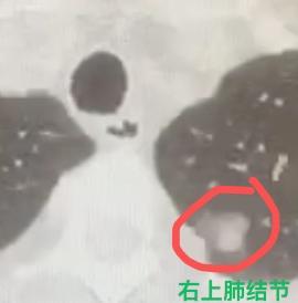 早期肺癌术后8年再长结节，已经是晚期肺癌了？！刚做完一台很有代表性的肺癌手术，想