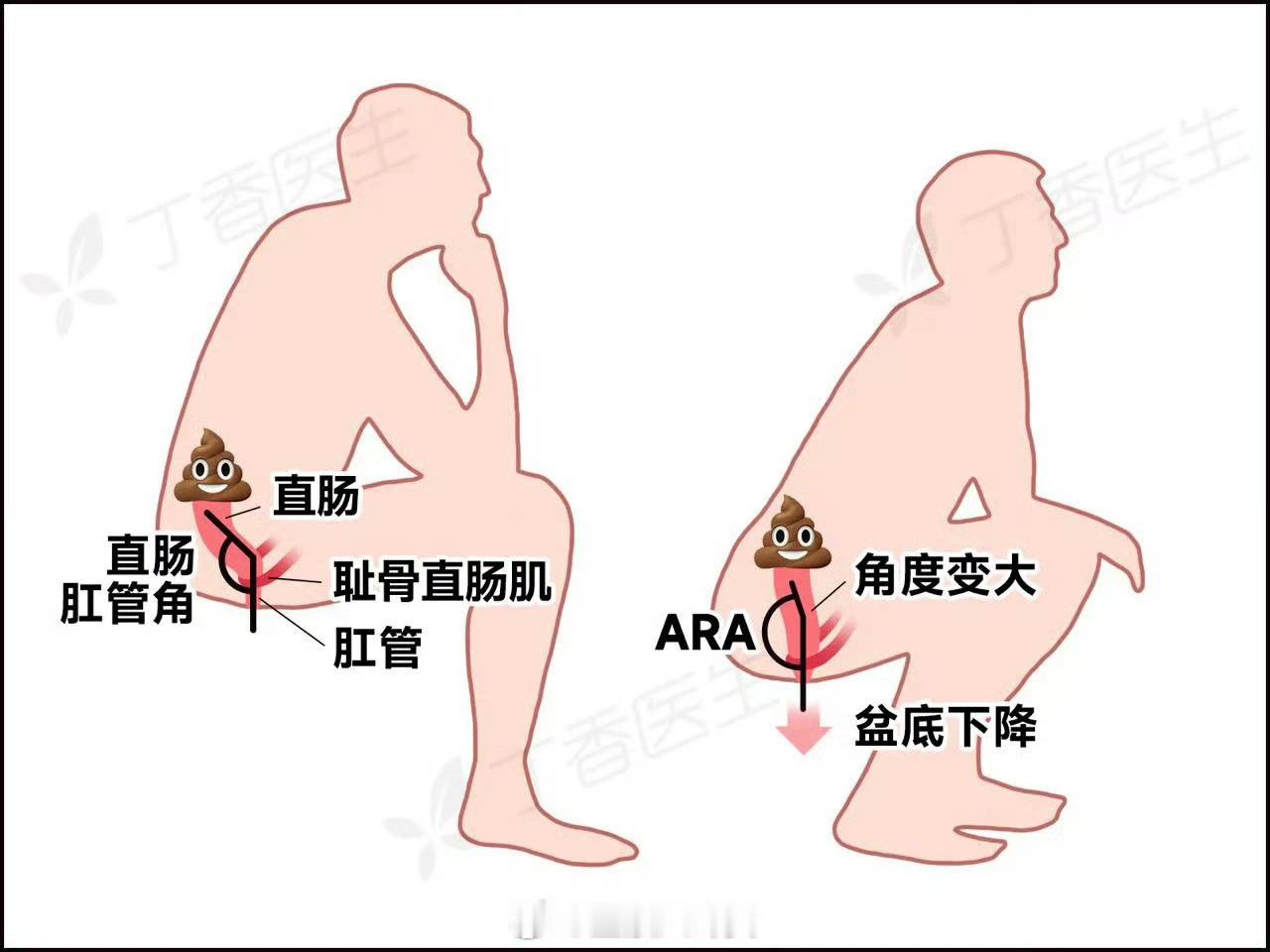 如果有条件，更推荐便秘星人蹲着拉