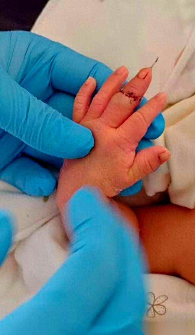 剪脐带，剪掉了孩子一截手指头。我看到这新闻的时候，后背都凉了。医院怎么说？说