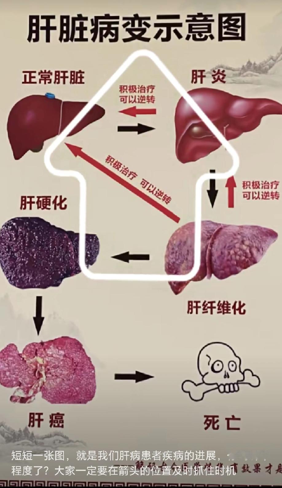 肝癌防治真的进入新阶段啦!我国是肝癌高发国,每年近40万新发病例,80%与乙肝病