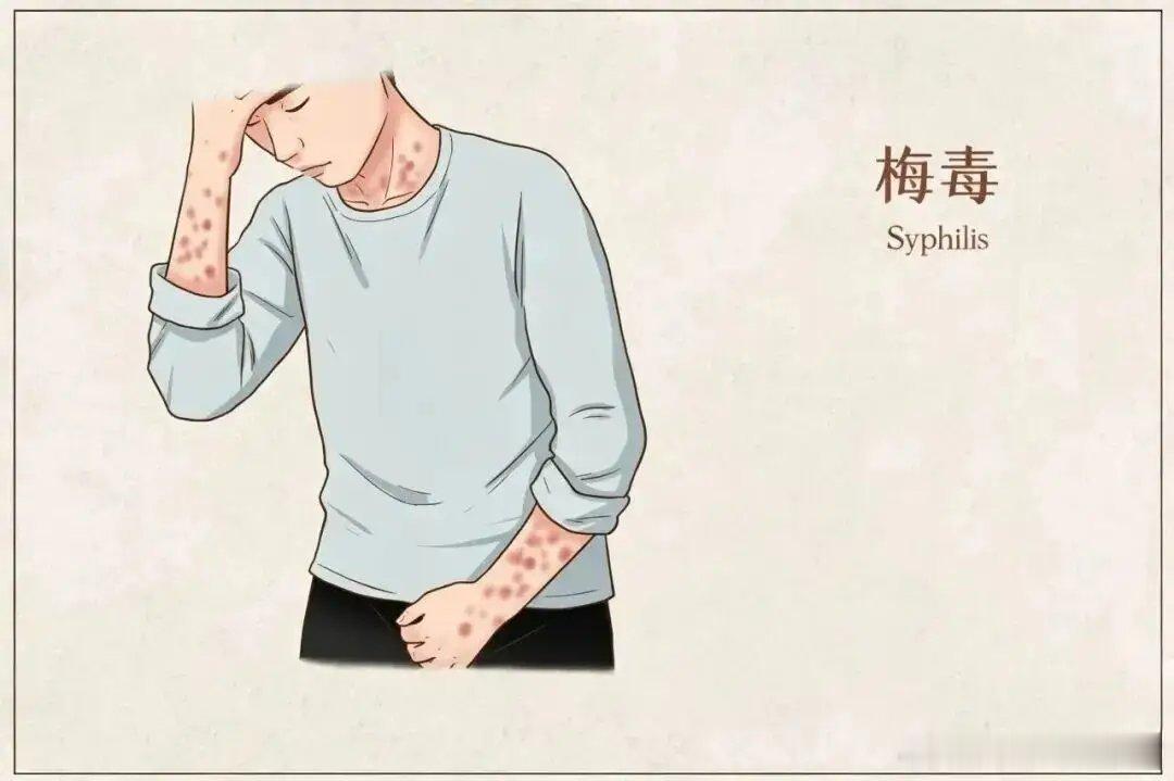 #男子大腿长红斑以为是股癣一查是梅毒#浙江杭州48岁张先生，大腿、腹股沟、会阴长出红斑伴随脱屑瘙痒，