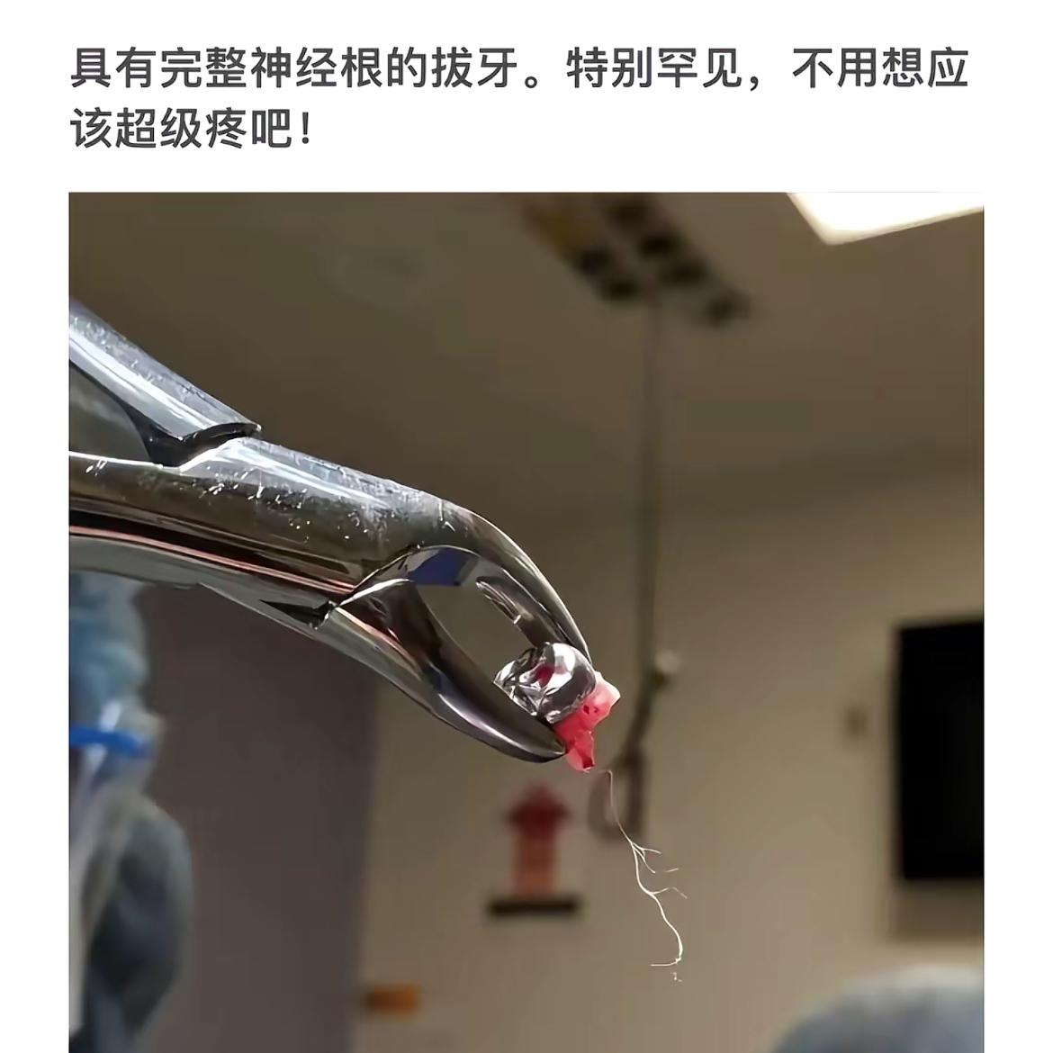 拔牙新体验：无痛拔牙，神经根完整！