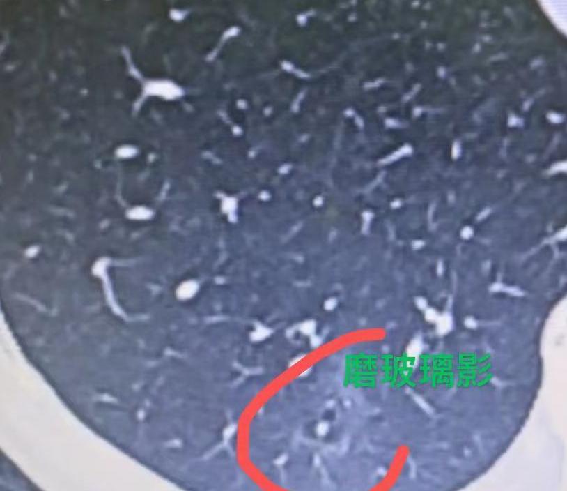 别被磨玻璃影、磨玻璃结节吓住，大多不是肿瘤！临床上经常能遇到因为胸部CT报告慌神