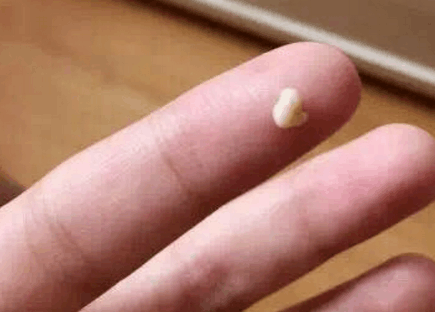咳出黄白色臭臭的小颗粒, 还口臭, 这是怎么了