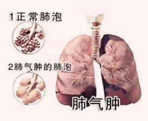 肺气肿是怎么发生的, 我们怎么才能知道是否患了肺气肿