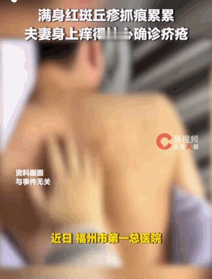 福建，一名男子在朋友家住了几天，回家后肚子、大腿痒得厉害。他以为是湿疹，天天用热