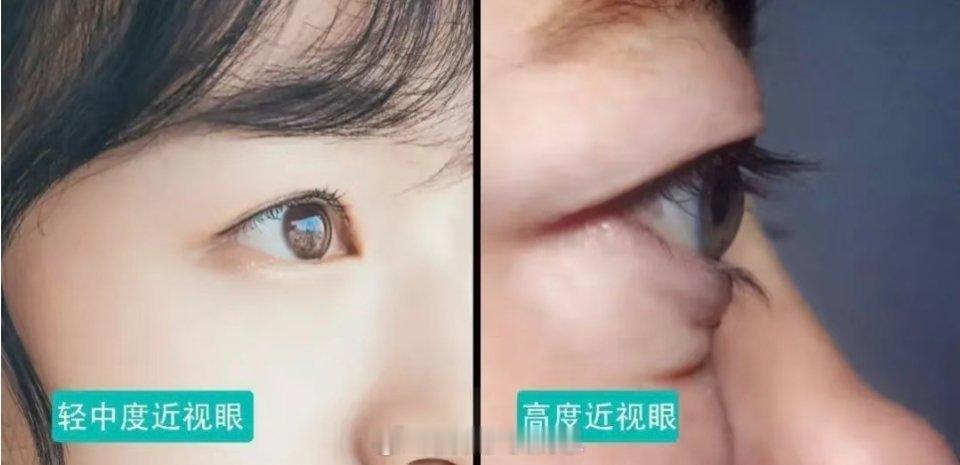 长期戴眼镜导致的面部变化我现在真觉得自己小时候好蠢,竟然因为喜欢戴框架眼镜,故意