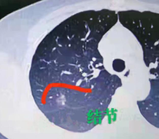 别把医生的“定期复查”当耳旁风！肺结节疏忽2年，后果太揪心......在临床工作