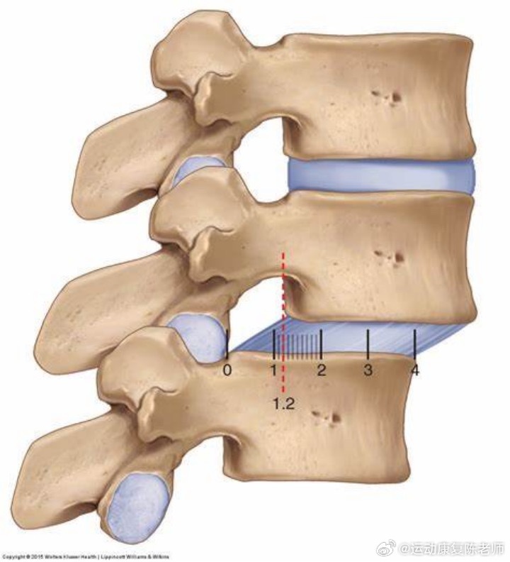 腰痛之前讲腰椎间盘突出、膨出比较多，今天就来详细讲讲另一个损伤——腰椎滑脱，它