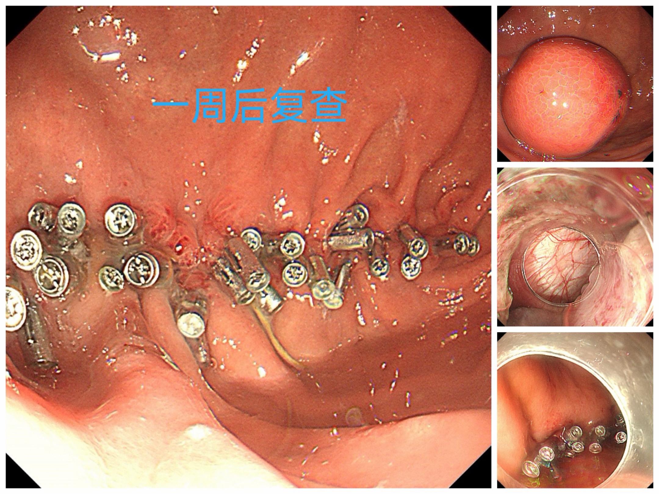 胃上切个5厘米的大洞，一周后竟然长这样！近期2个5厘米的大间质瘤，胃镜...