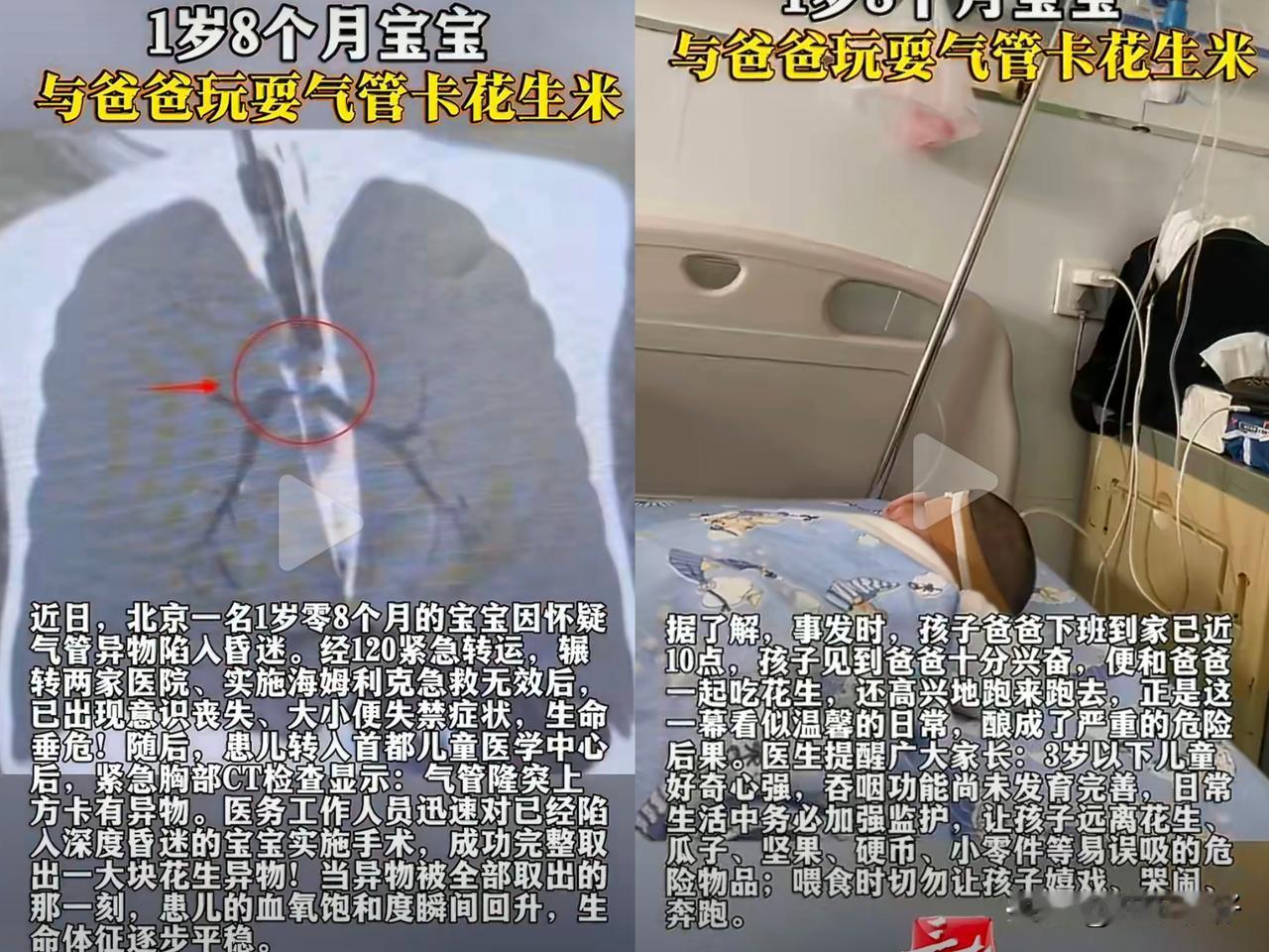 1岁宝宝因爸爸喂食花生米险丧命，春节聚餐这些“隐形杀手”家长务必警惕！