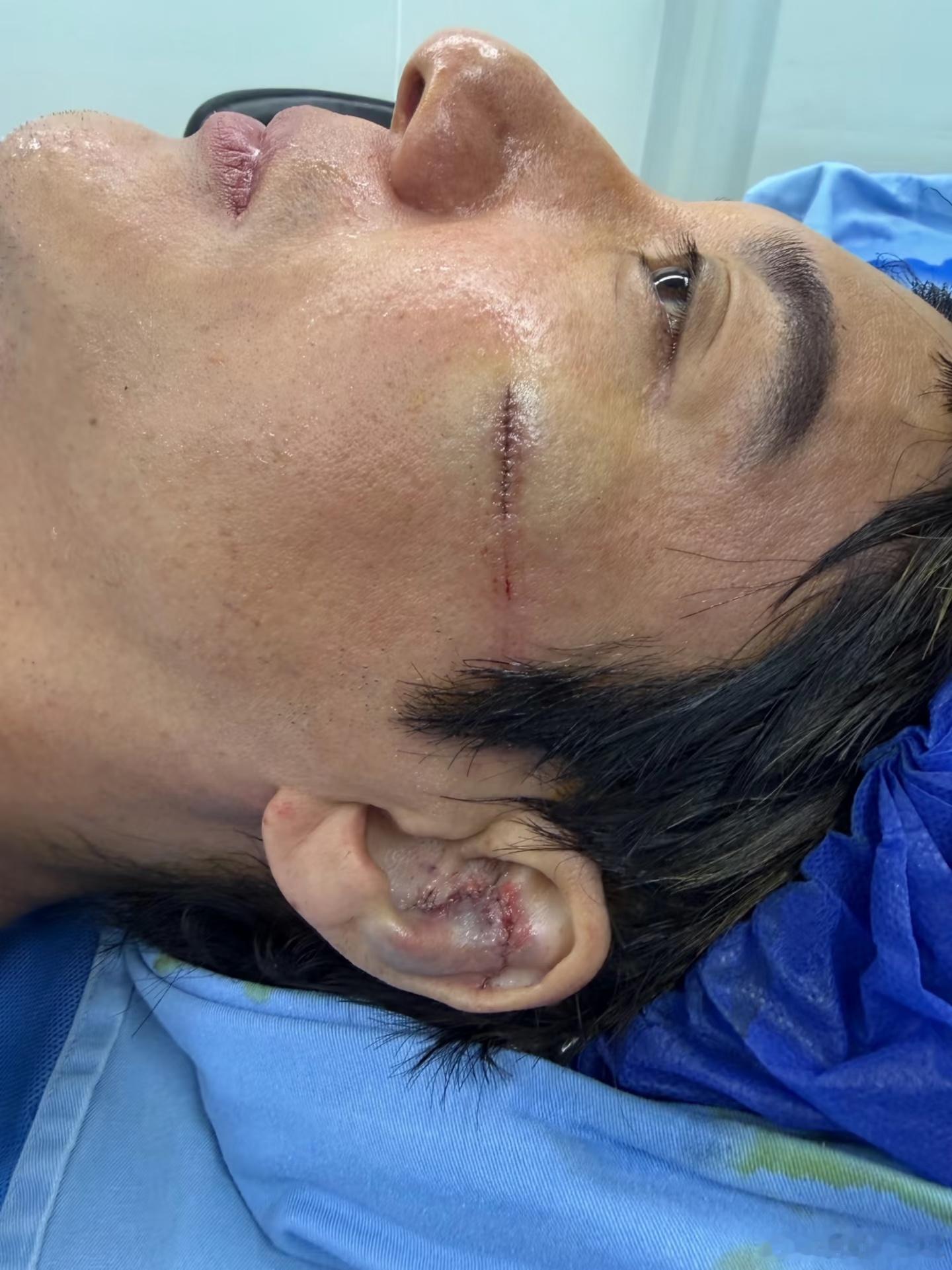 王力宏缝了39针不幸中的万幸。只是伤到了外耳骨和脸部皮肤，都没有受到任何损伤。哥