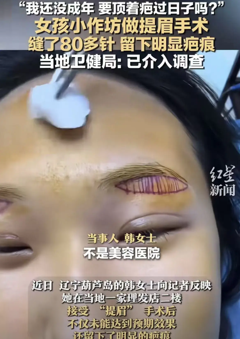 辽宁葫芦岛，一名未满18岁的女孩，在一家理发店的二楼做了个双眼皮埋线，术后11天
