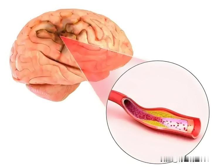 脑血管病用药不用愁！西药+中成药聊透，脑梗、脑动脉硬化都对症家里有人得脑梗