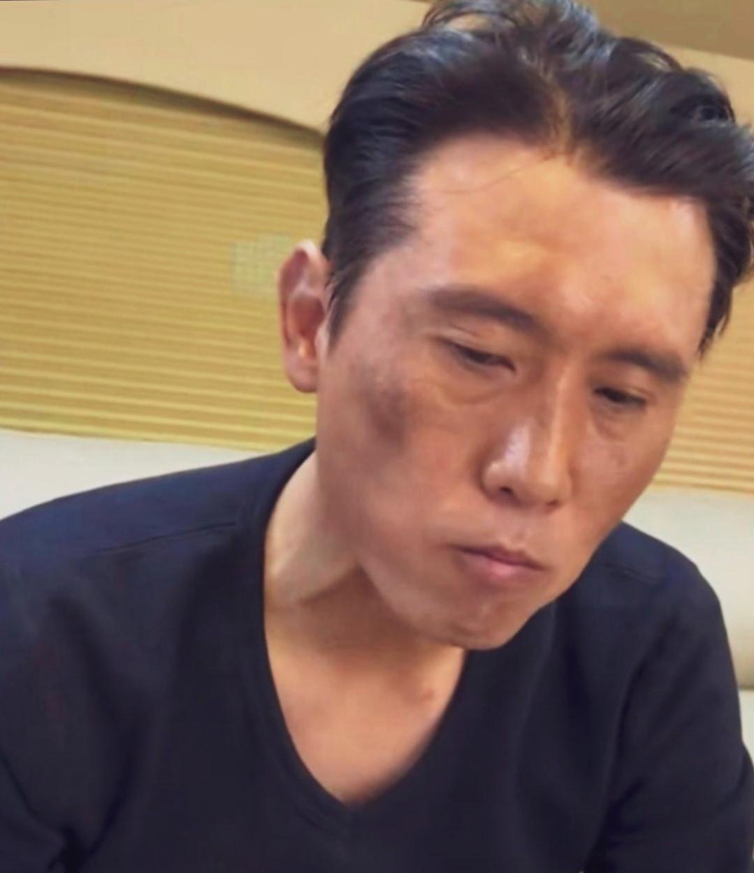 李乃文梳着大光明发型，面色特别憔悴，皮肤还有斑块，瘦脱相了！#李乃文#