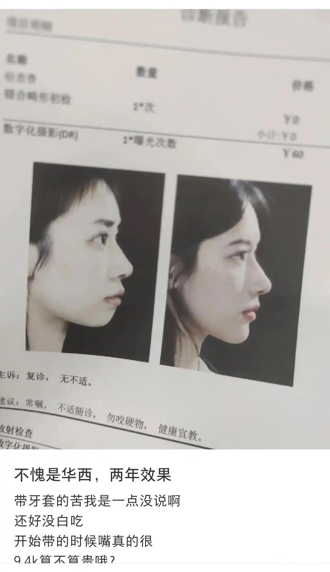 整容好了是真好看，但是也有不成功的，做之前还是三思而后行！