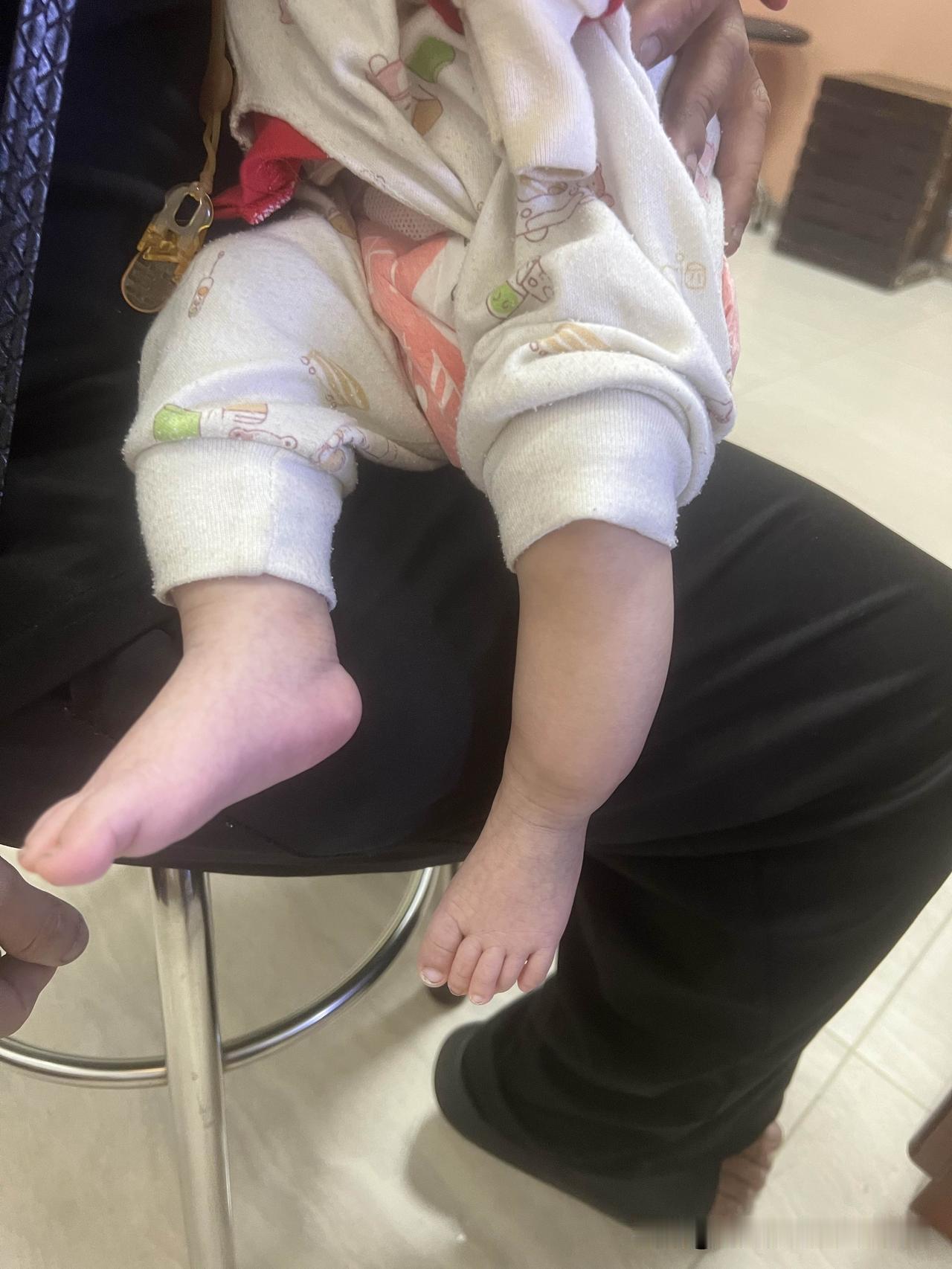 小孩小腿骨折，家长却不知道怎么回事？2个月大的宝宝，家长发现左侧小腿有些肿，于