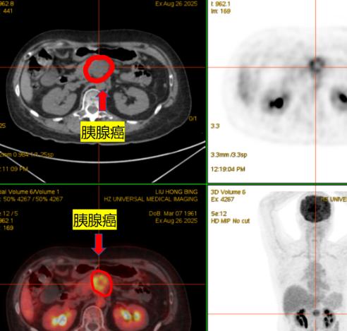 别再盲目节食了！19岁女学霸省生活费少吃饭，确诊胰脏癌晚期，家人倾家荡产救她