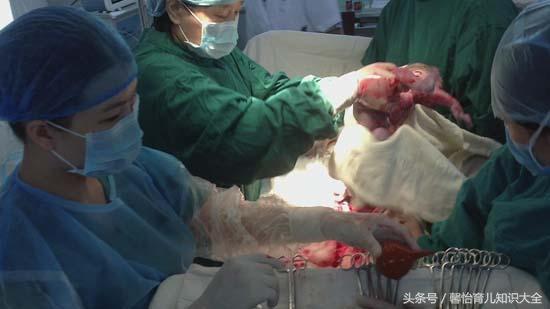 孕妇顺产龙凤胎, 大喊“肚子还会动”, 一番检查又获惊喜