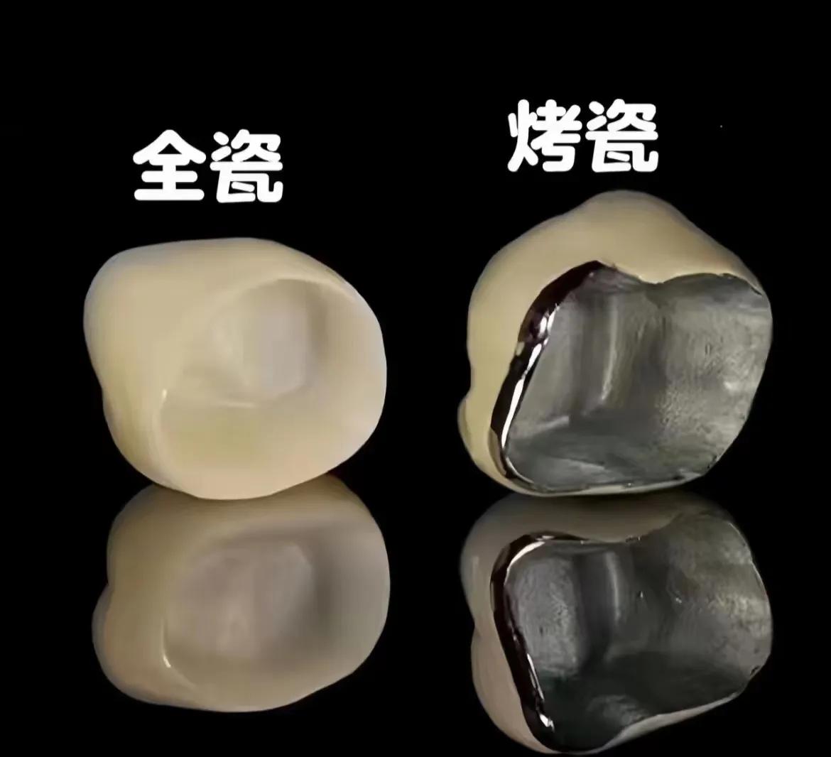 牙套！[无奈吐舌]细节，建议看看！牙冠部分损坏，但牙根还在，这时候可以带个牙套