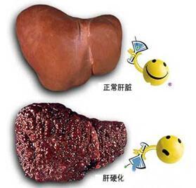 肝硬化, 5个症状最明显! 能发现一个就很好