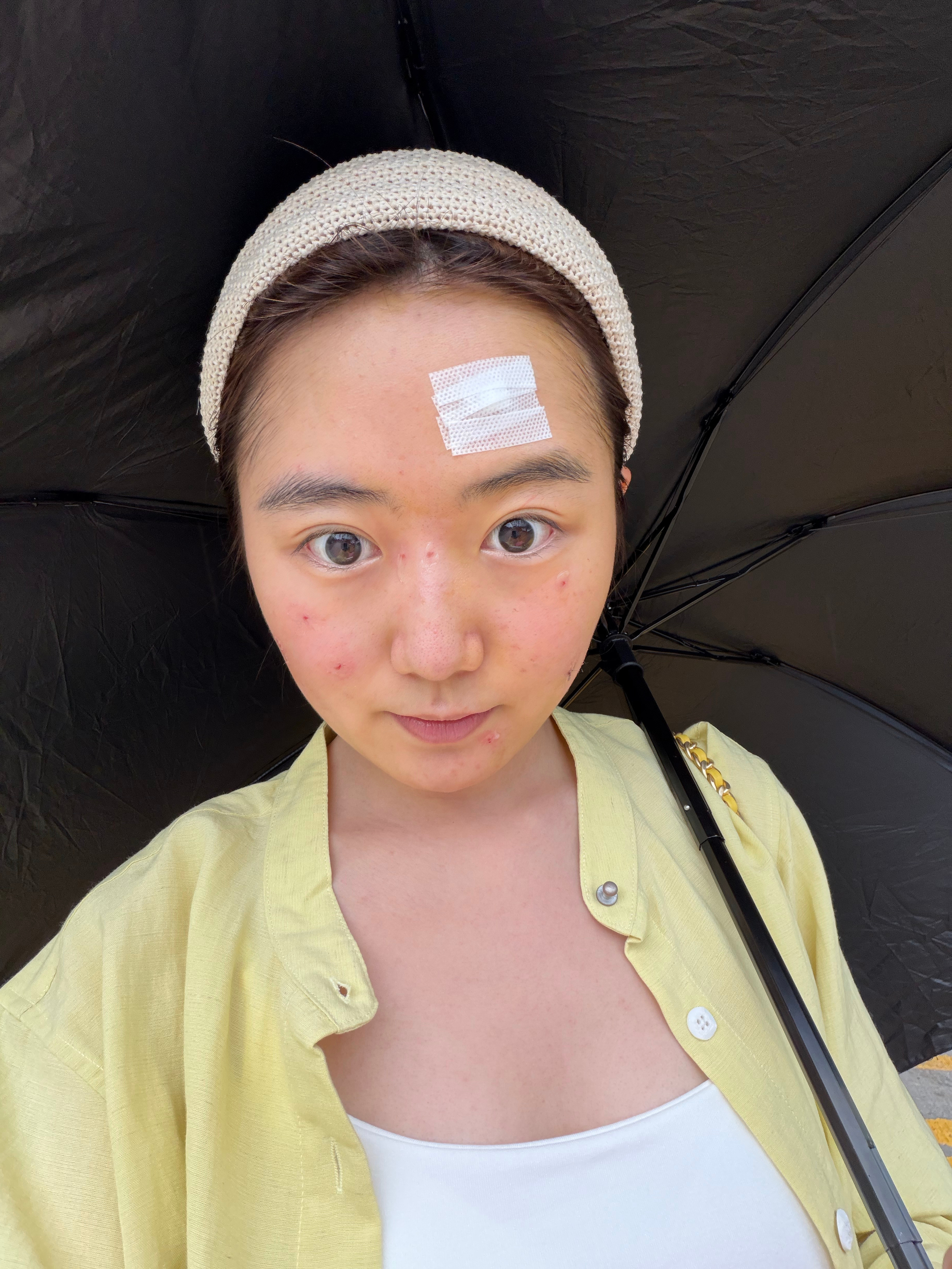 祛完了。回来爷爷家吃饭背景音是我爷爷在骂我哈哈哈哈12颗～三颗开刀九颗激光。