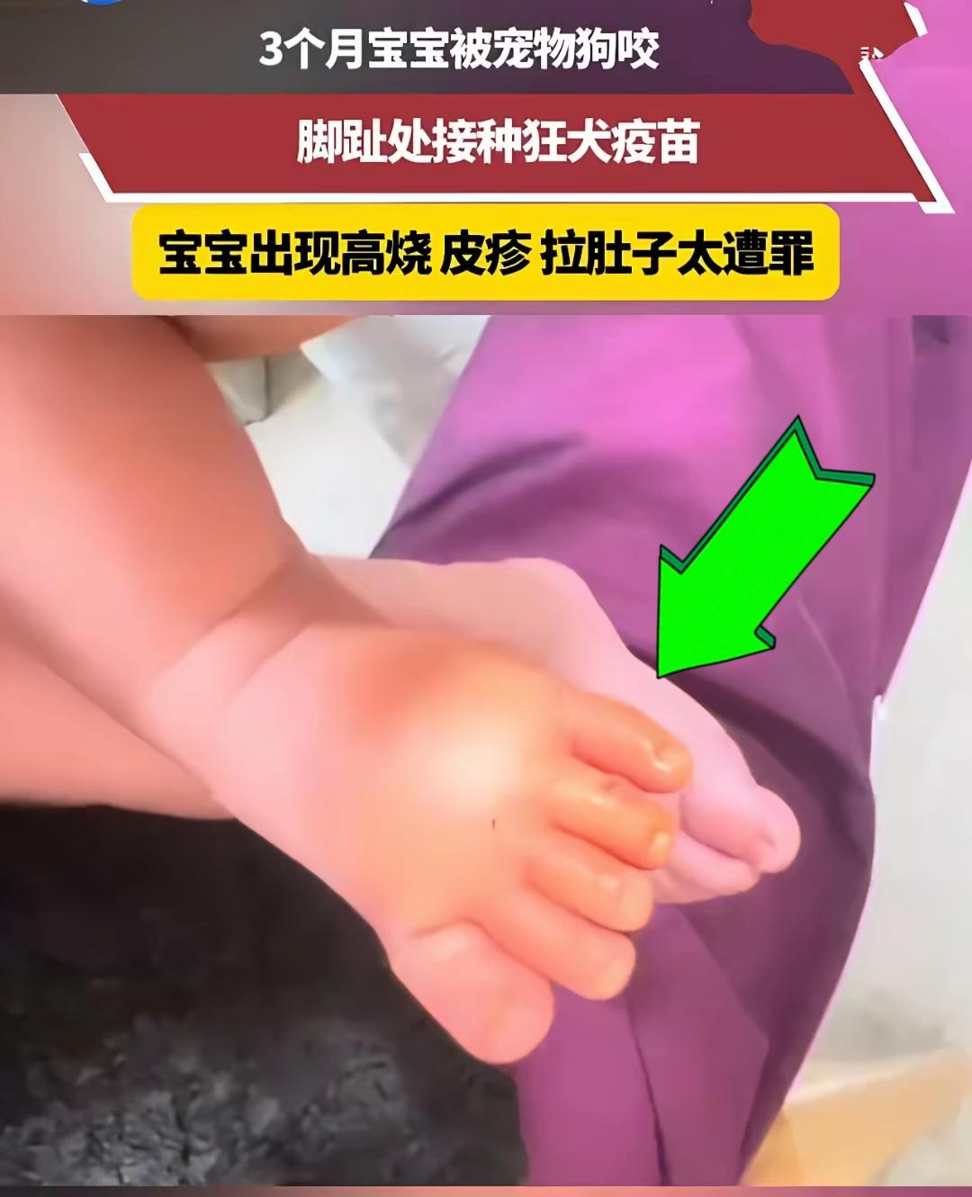 太遭罪~三个月宝宝喝奶时，被隔壁家的宠物狗狠狠咬了脚趾。宝妈赶紧带孩子接种狂犬疫