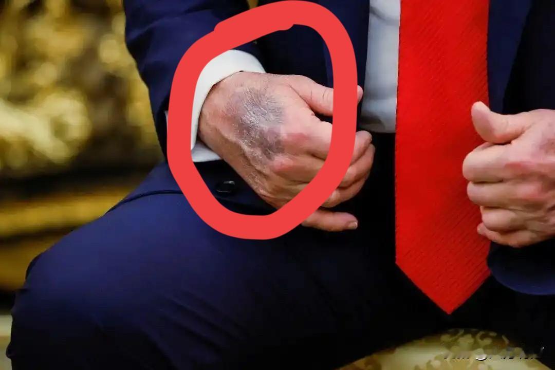 79岁，白宫主人，手背上一片片淤青，看着有点触目惊心。外界都在猜是不是打点