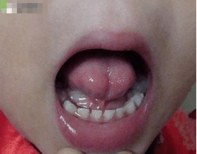 快看看你家孩子是不是这样的舌头! 是的话就要注意了