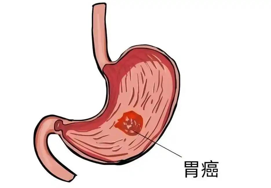 胃癌不痛不痒？医生提醒：饭后如果存在4个表现，建议尽早做胃镜饭吃得好好的，怎