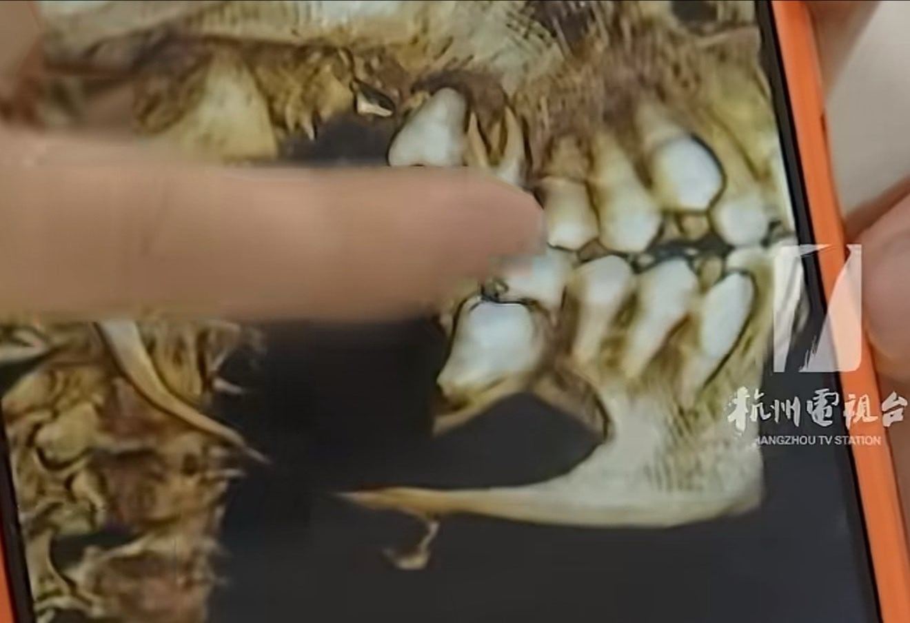 11岁男孩脸肿竟是肿瘤骨头断了脸肿了，谁能想到是肿瘤把骨头都弄断了？太吓人了