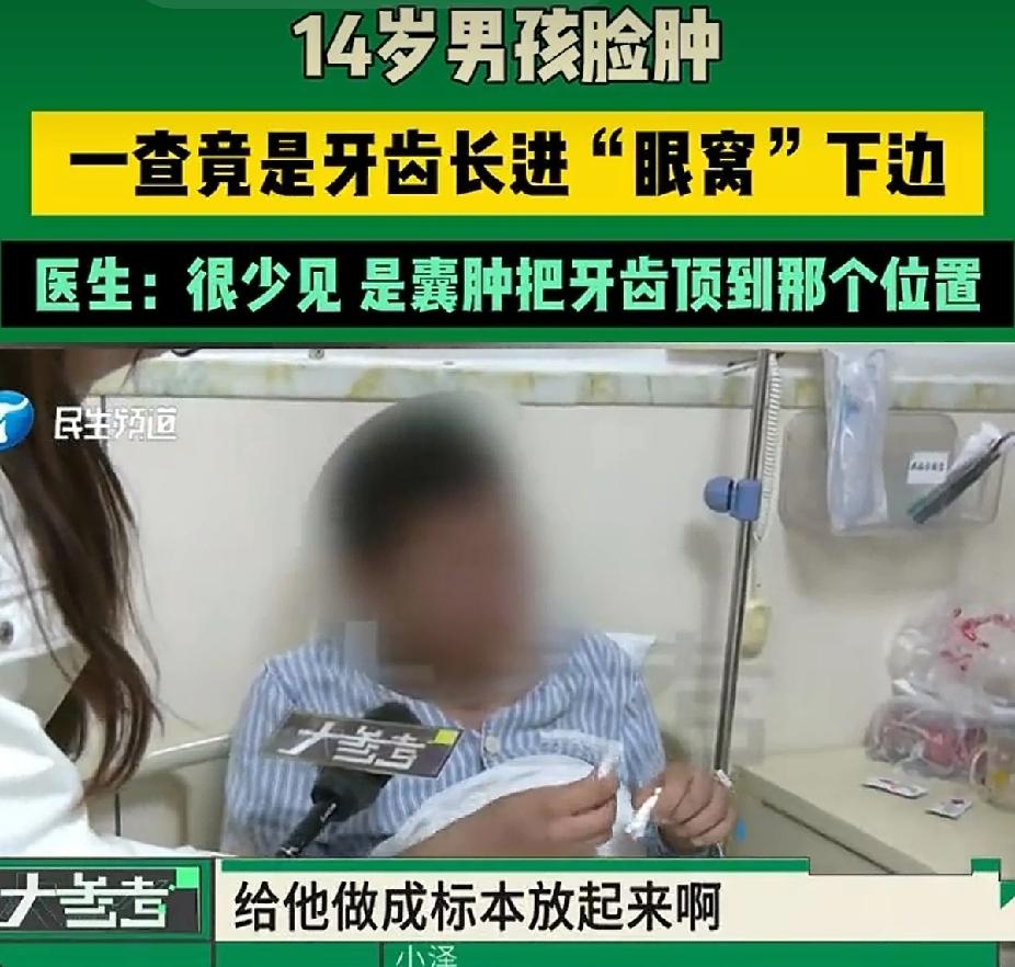 “吓出冷汗”！河南一名14岁少年，左脸颊越来越鼓，家长还以为是青春期发胖，或牙龈