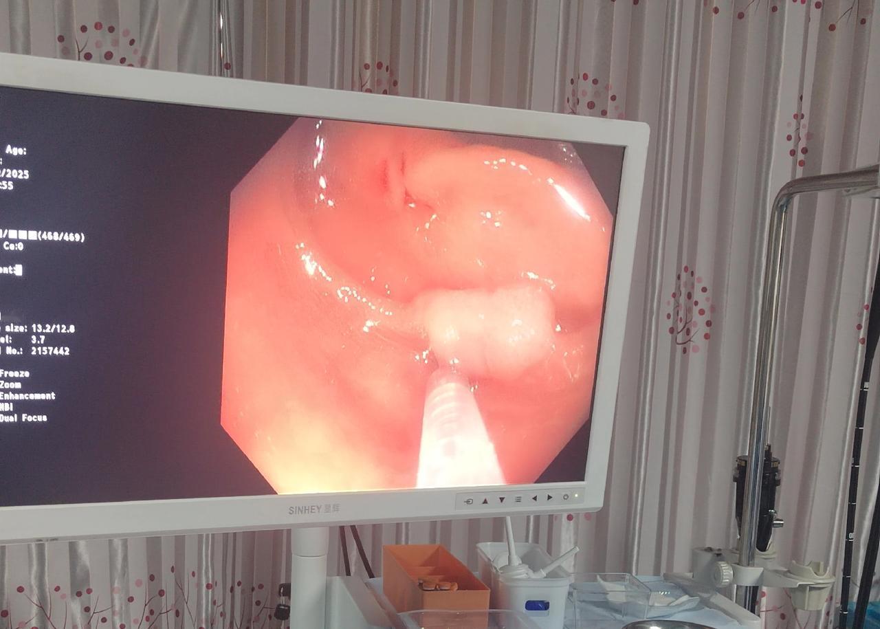 5年前肠子里没有息肉，并不代表它就不长息肉了。今天一位65岁的大妈在医院里做