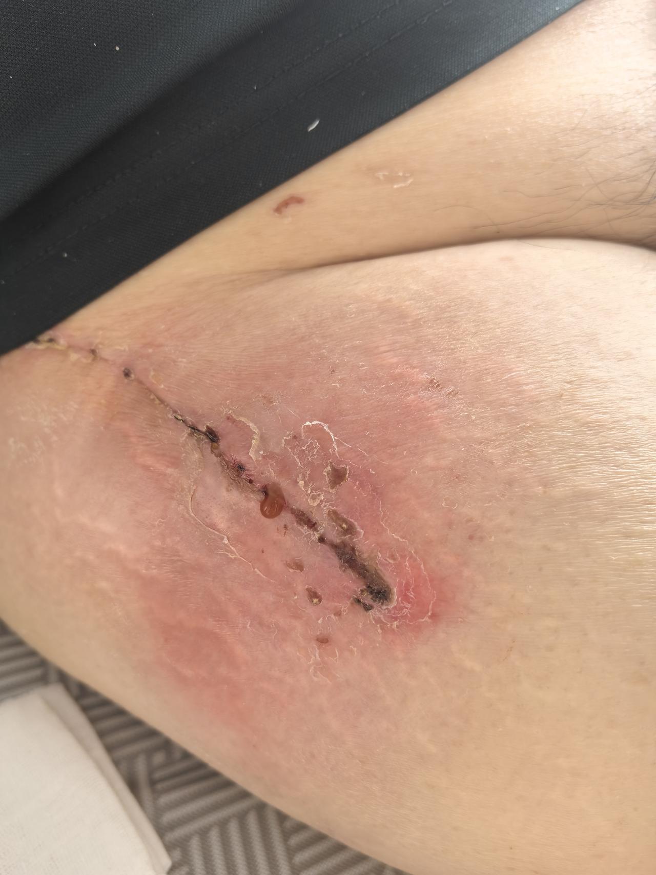 我爸髋关节翻修术手术后的第十七天。今天去我爸那里坐了一会儿，看见刀口处一个劲