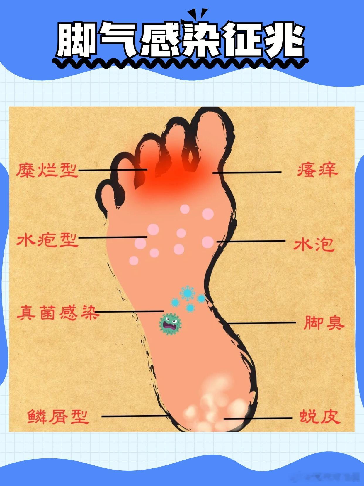道家养生│如何治疗脚气？有人说：脚气是夏天最尴尬的“顽疾”，没有之一。穿鞋闷一