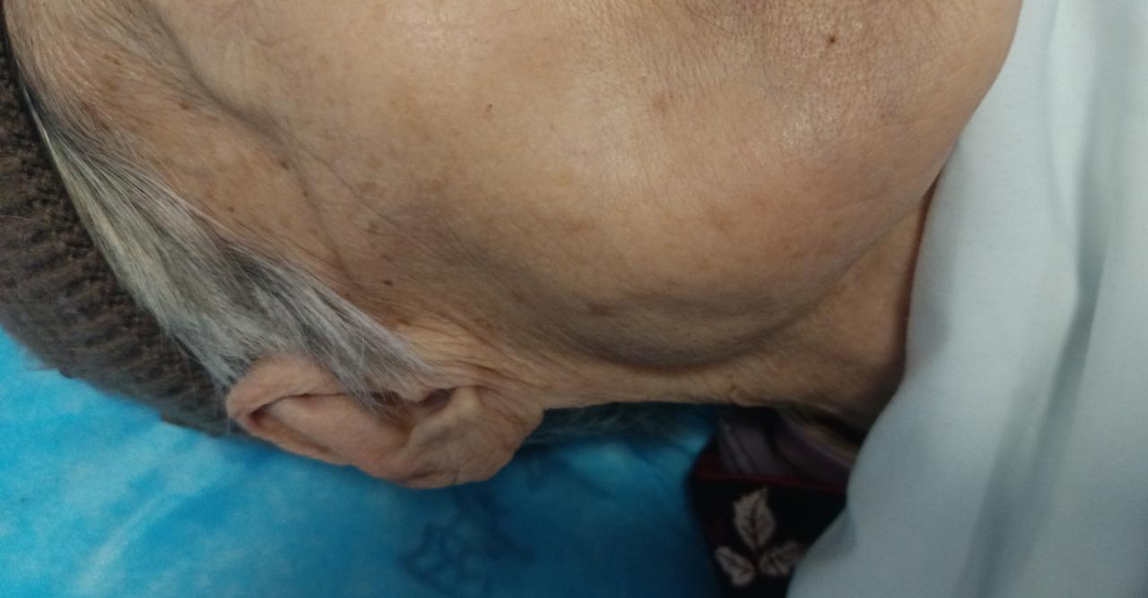 老人这种情况，只好放弃治疗!老太太9号开始牙疼，10号早上发现腮帮子肿胀，立即